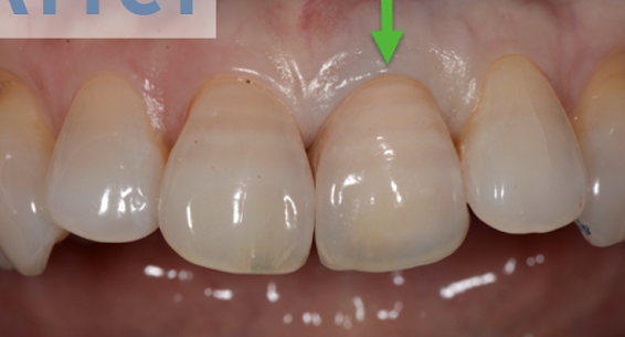 見た目が自然な入れ歯あります