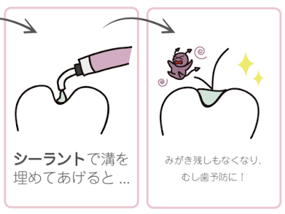 永久歯をむし歯から守るシーラント治療