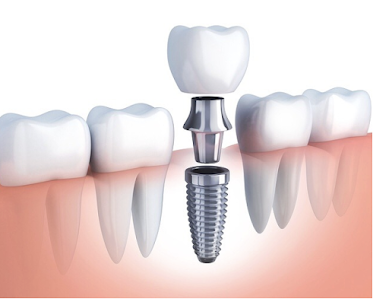 歯が無い部分へのインプラント治療
