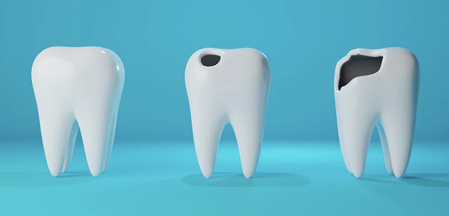 同じ歯の再治療で抜歯になることも??