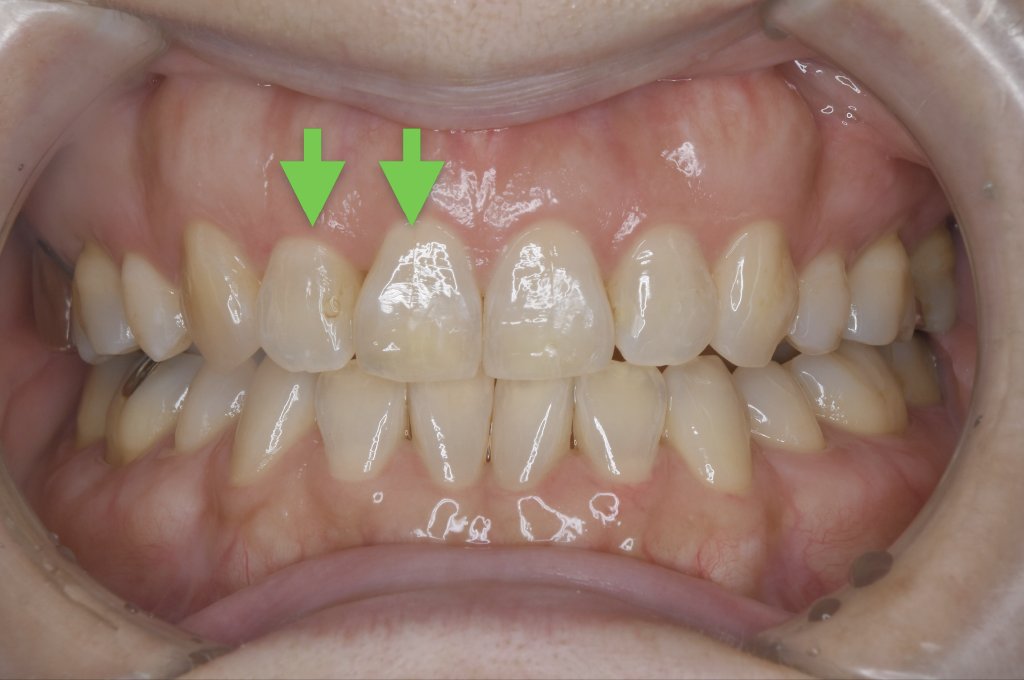 歯科仙川の症例一覧｜1AFTER