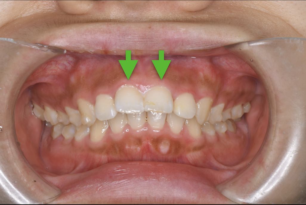 歯科仙川の症例一覧｜1BEFORE