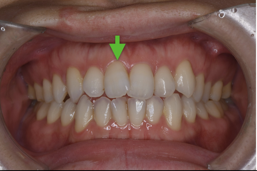 歯科仙川の症例一覧｜1BEFORE