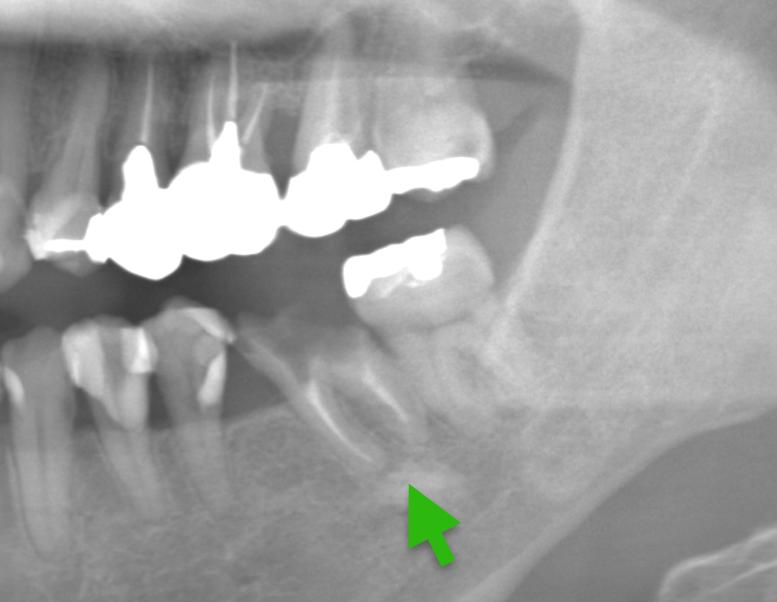 歯科仙川の症例一覧｜1BEFORE