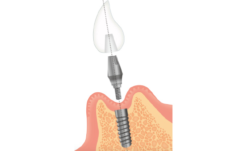 インプラント治療とは